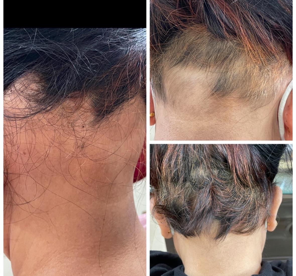 Alopecia Areata