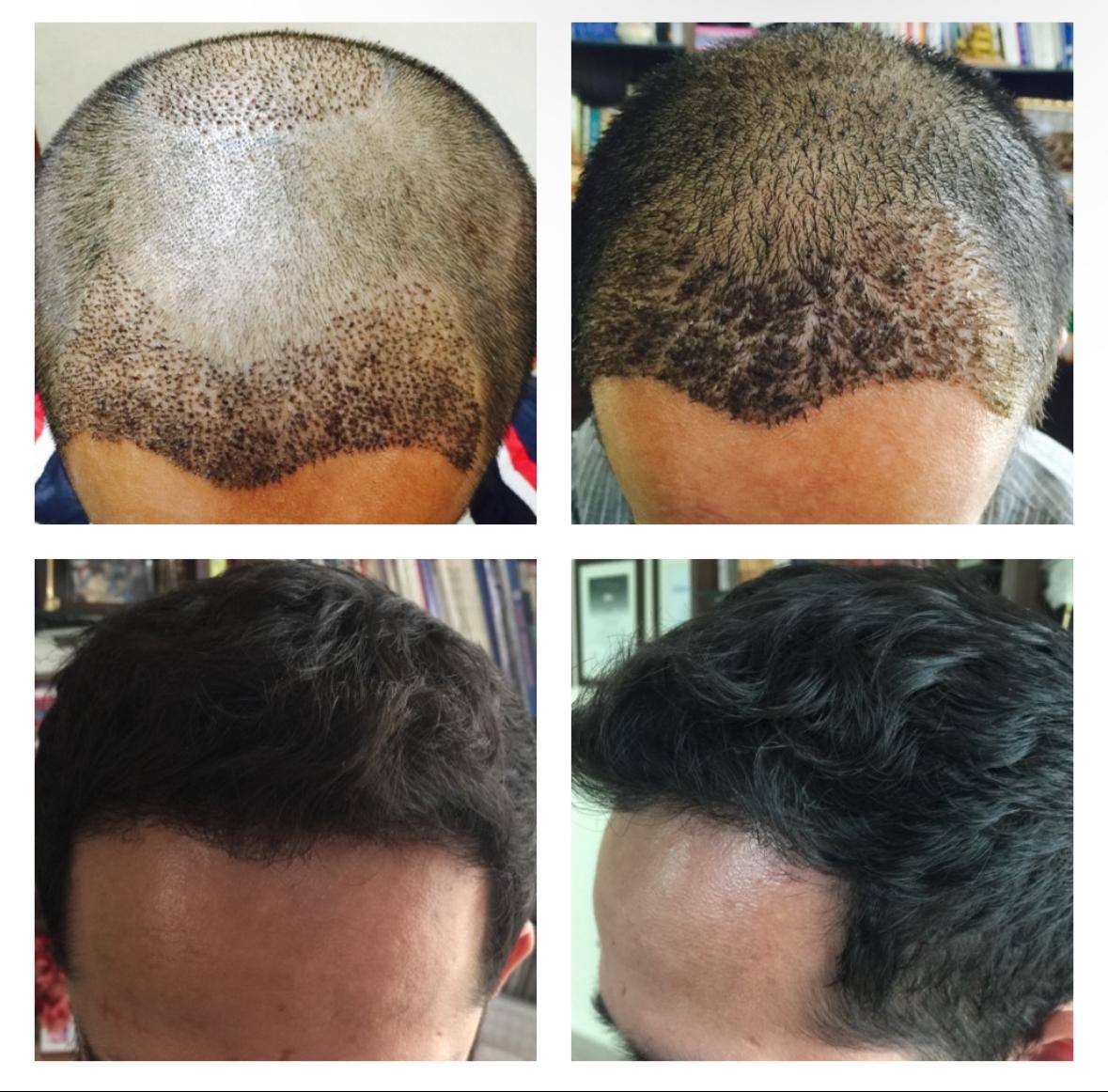 Hair Transplant