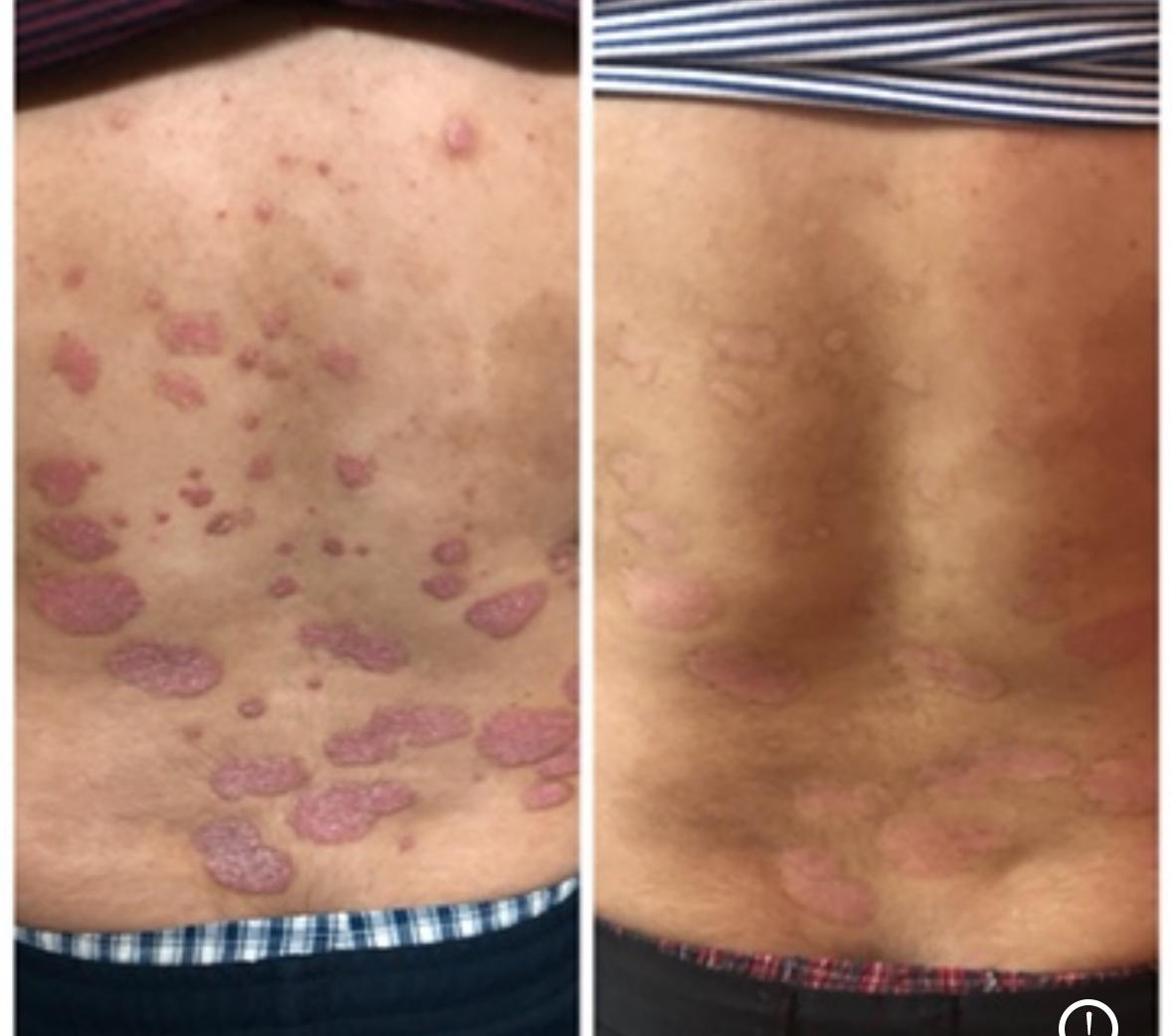 Psoriasis